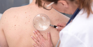 Alimentação rica em fibra melhora resposta de doentes com melanoma à imunoterapia