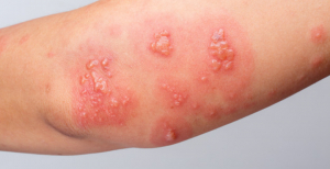 Herpes pode ser o novo sintoma raro associado à toma da vacina contra a COVID-19