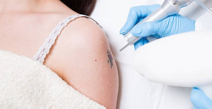 Non-laser and non-surgical removal methods of tattoos: a call to action