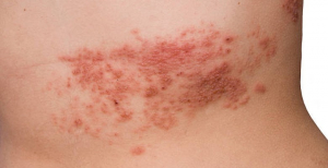Vacina para prevenção do herpes zoster já está disponível em Portugal