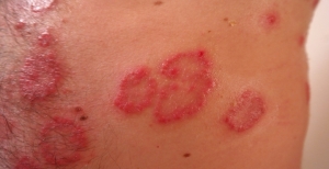 COVID-19: International Psoriasis Council emite recomendações
