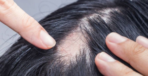 Quais os tipos de cabelo com maior propensão para a alopecia ou que condicionam os transplantes capilares?