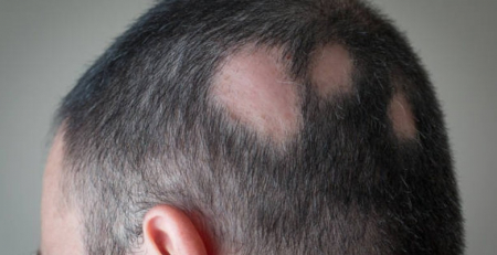 Patient-Reported Outcomes e a avaliação clínica para alopecia areata
