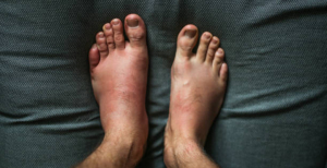 &quot;Devemos suspeitar de angioedema hereditário sempre que haja uma história da patologia recorrente com envolvimento cutâneo&quot;